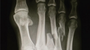 Kelly Slater se blesse au pied à J-Bay